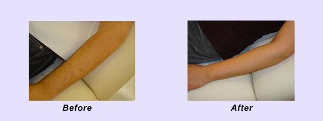 Laser Hair Removal Miami hair removal miami before after Laser Hair Removal Miami