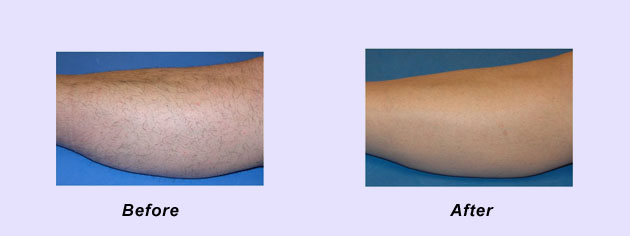Laser Hair Removal Miami laser hair removal miami fl Laser Hair Removal Miami