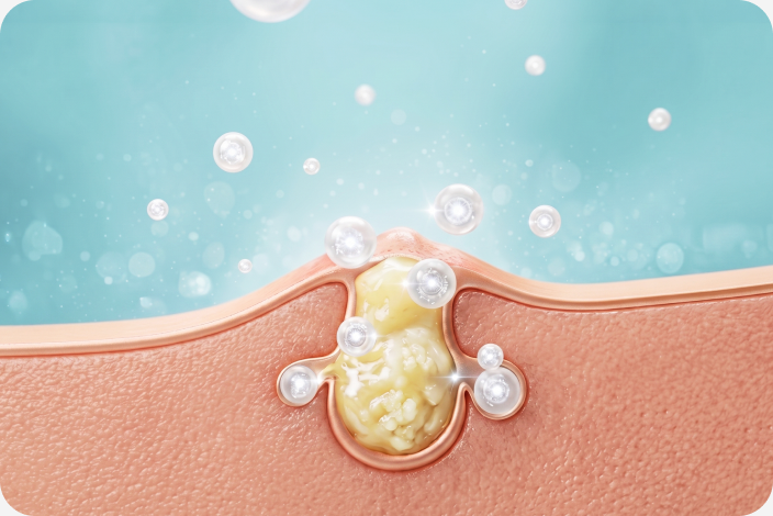 Illustration explaining the Acne Max topical formula