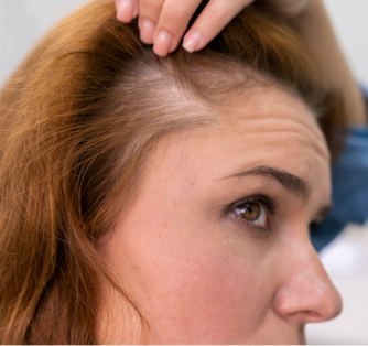 Female Hair Loss: Guide to Finasteride, Minoxidil & Ketoconazole