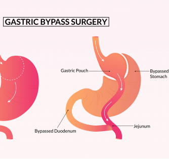 Is Gastric Bypass Covered by Insurance?