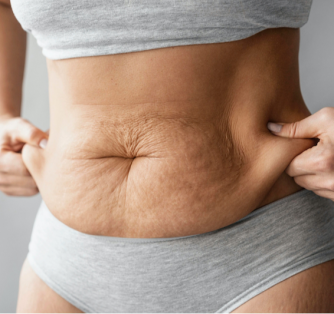 How to Avoid Loose Skin After Weight Loss